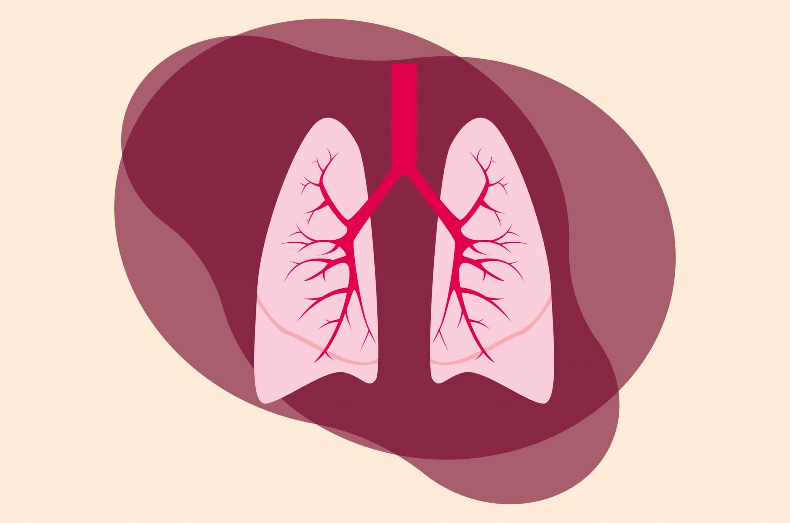 Pneumonia adalah